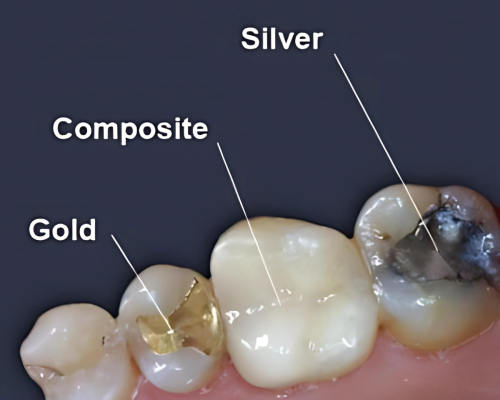 dental fillings