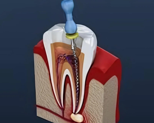 root-canal-tratment